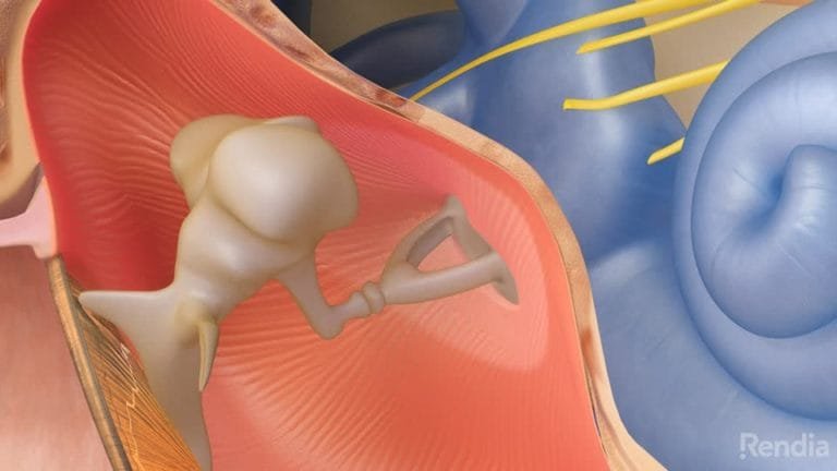 Pengertian otosklerosis