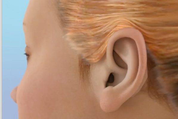 Ciri-Ciri Infeksi Pada Telinga